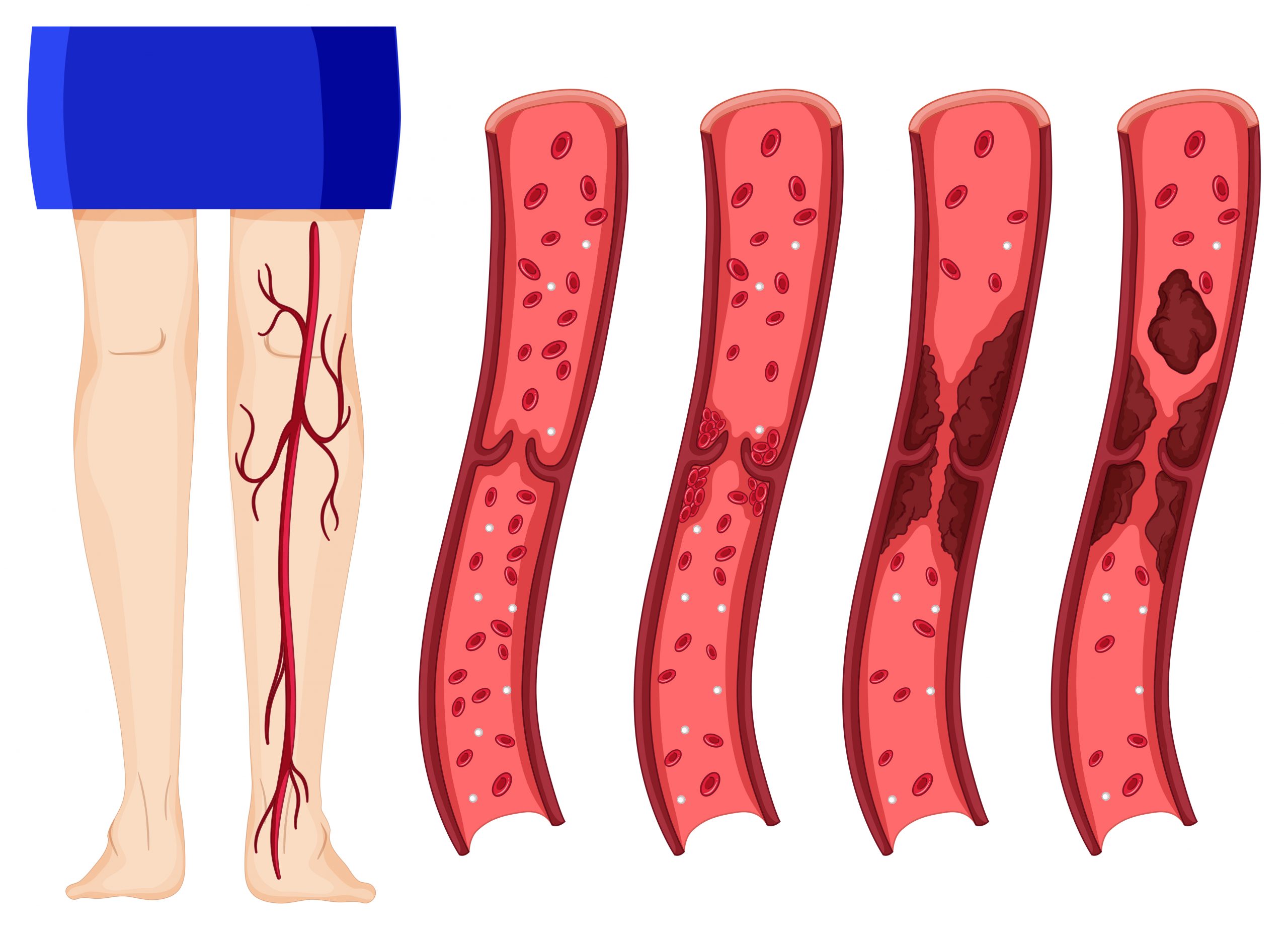 Your Body Warns You About a Blood Clot: 8 Hidden Signs You Must Never Ignore