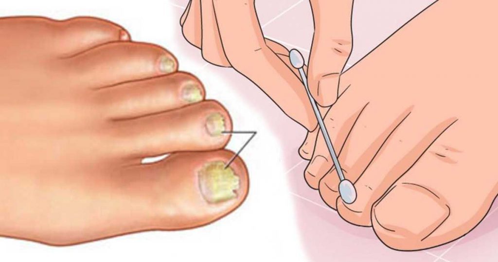 Say goodbye to fungal nails with this simple homemade remedy!