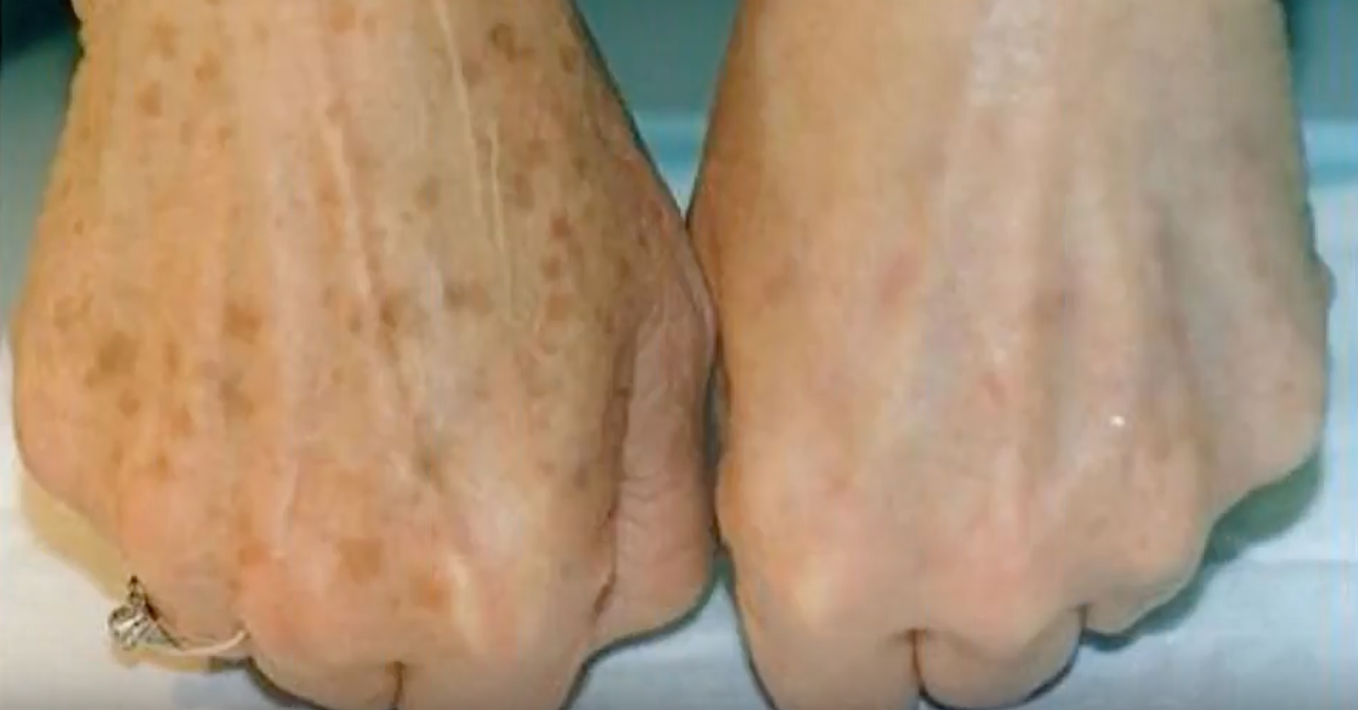 This Basic Kitchen Ingredient Can Help With Age Spots