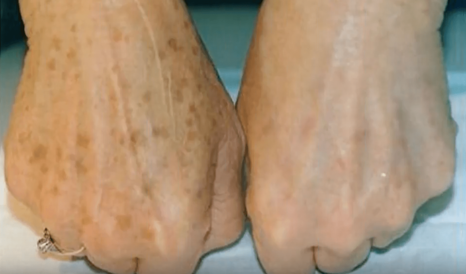 Do you suffer from age spots on your skin? You can get rid of them in no time with this simple trick!