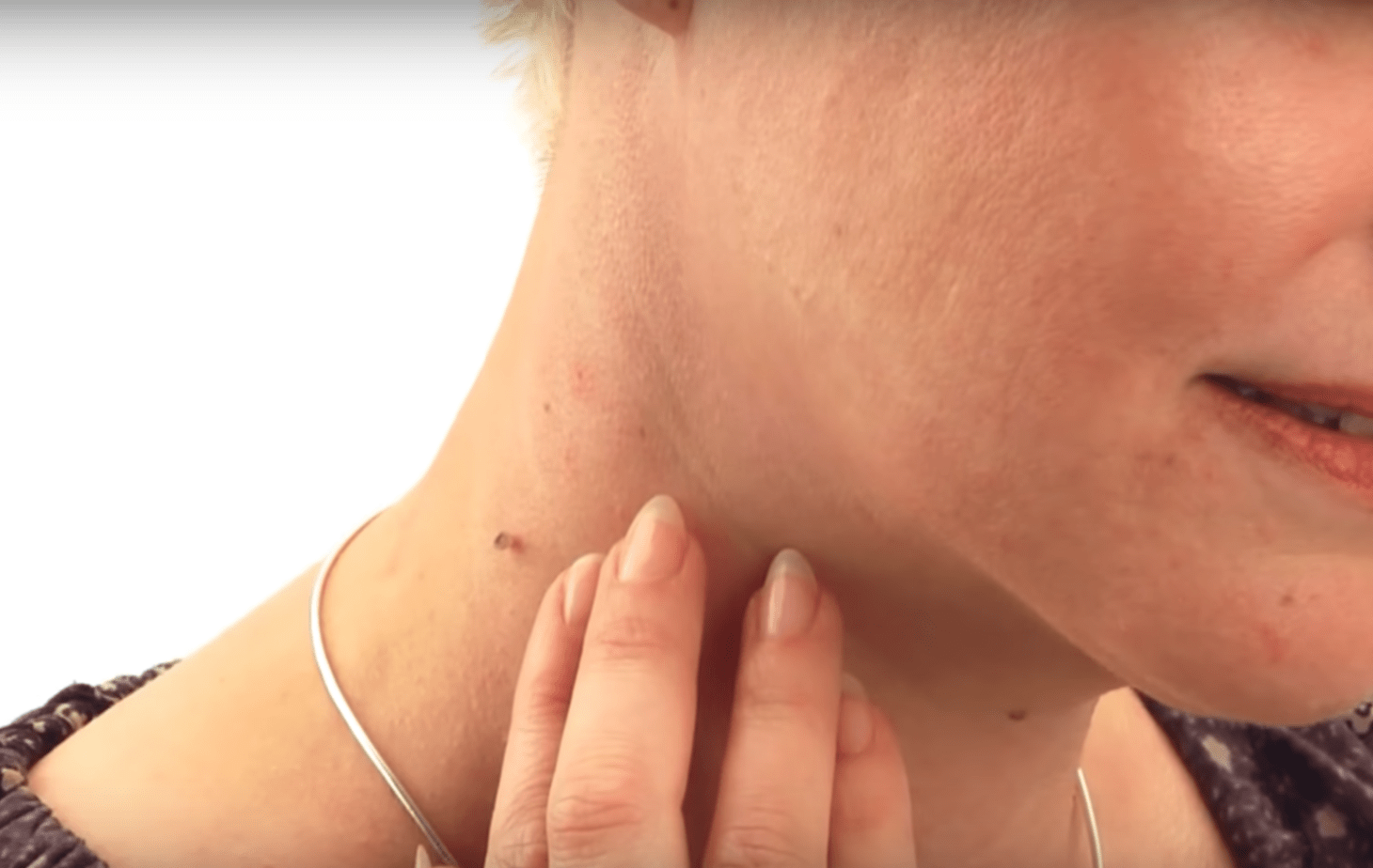 Do you have skin tags? This amazing trick will help you get rid of them in an easy and painless way!